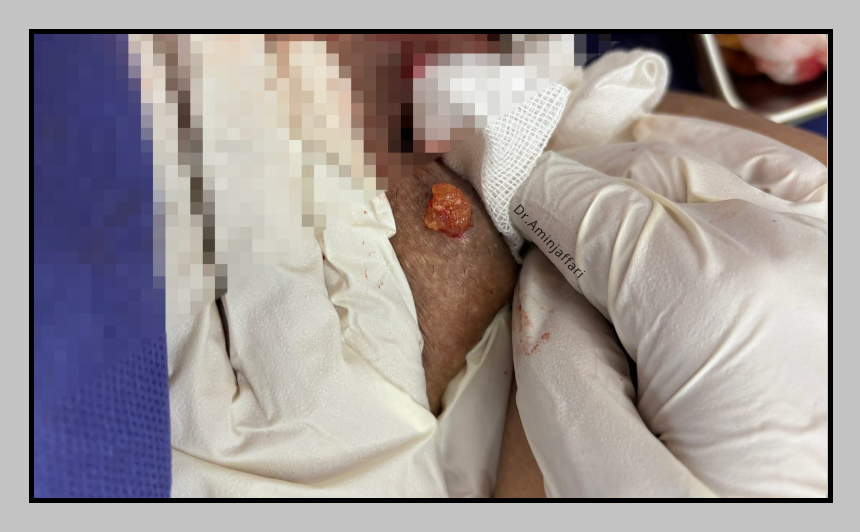 إزالة الفيلر بطرق آمنة الکتر امی جعفری