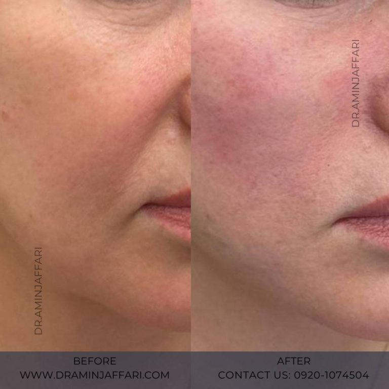 اندولیفت دکتر امین جعفری (10)