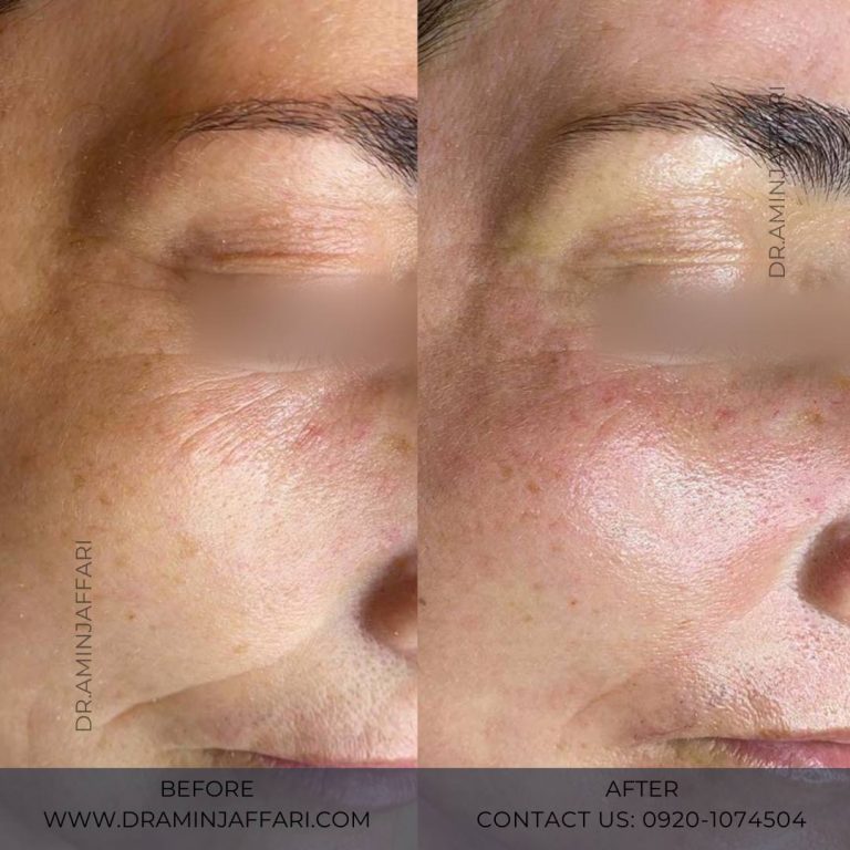 اندولیفت دکتر امین جعفری (11)