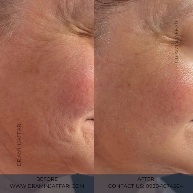 اندولیفت دکتر امین جعفری (12)