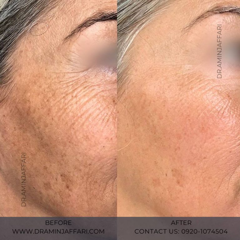 اندولیفت دکتر امین جعفری (13)