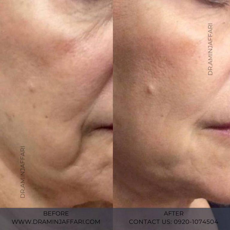 اندولیفت دکتر امین جعفری (3)