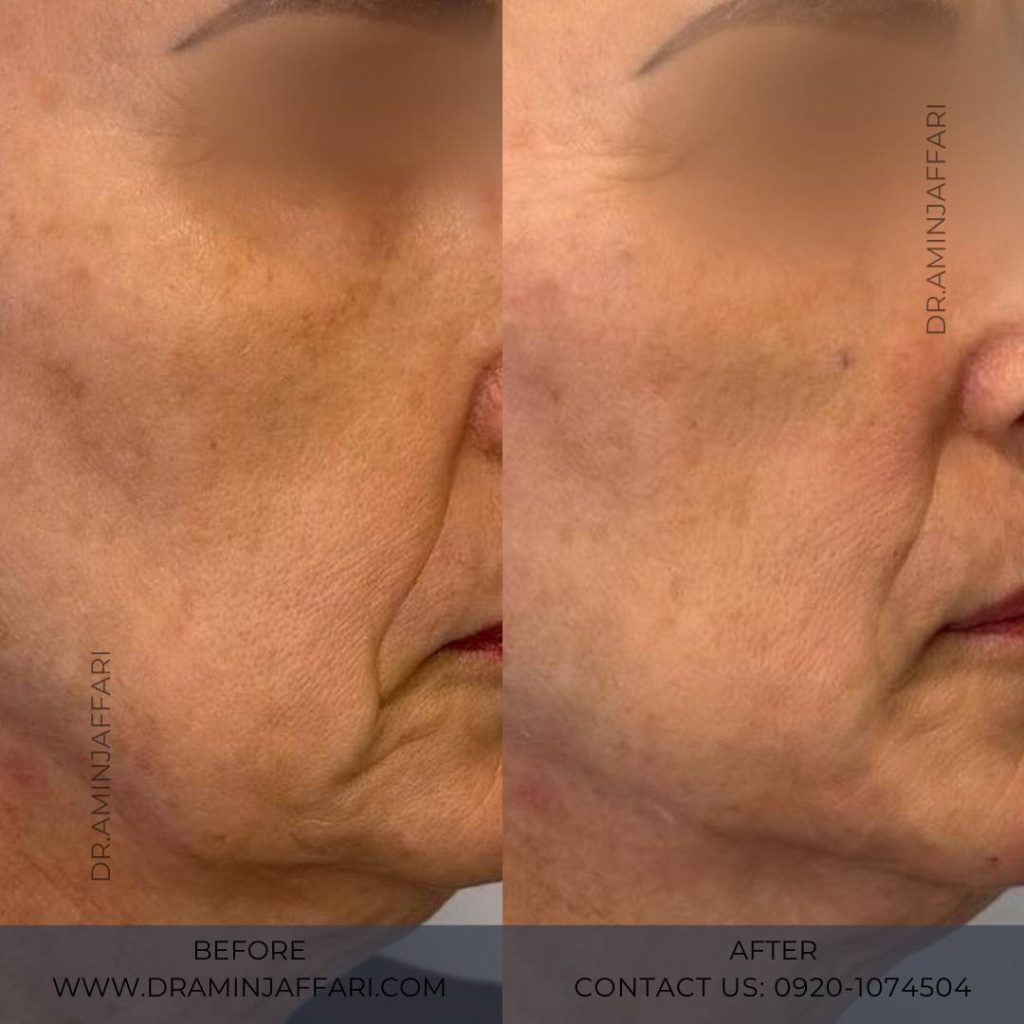 اندولیفت دکتر امین جعفری (4)