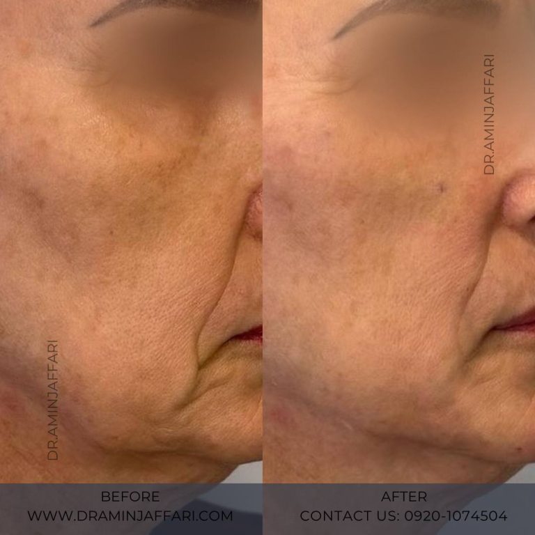 اندولیفت دکتر امین جعفری (4)