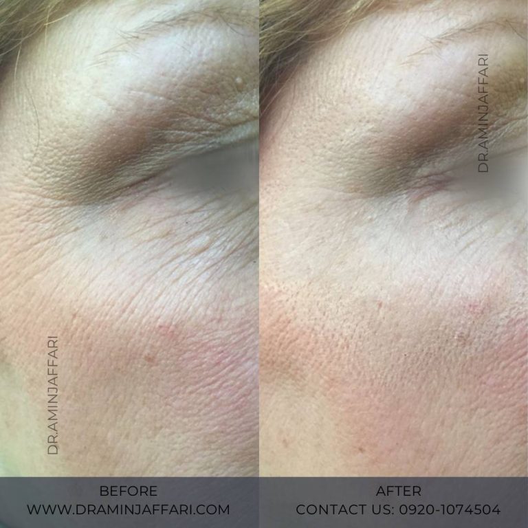 اندولیفت دکتر امین جعفری (6)