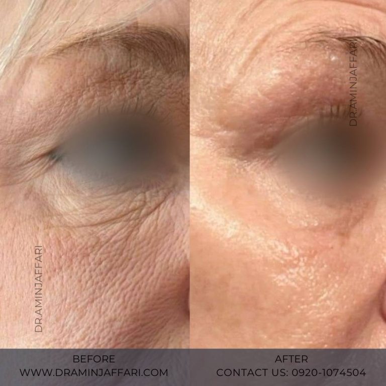 اندولیفت دکتر امین جعفری (7)