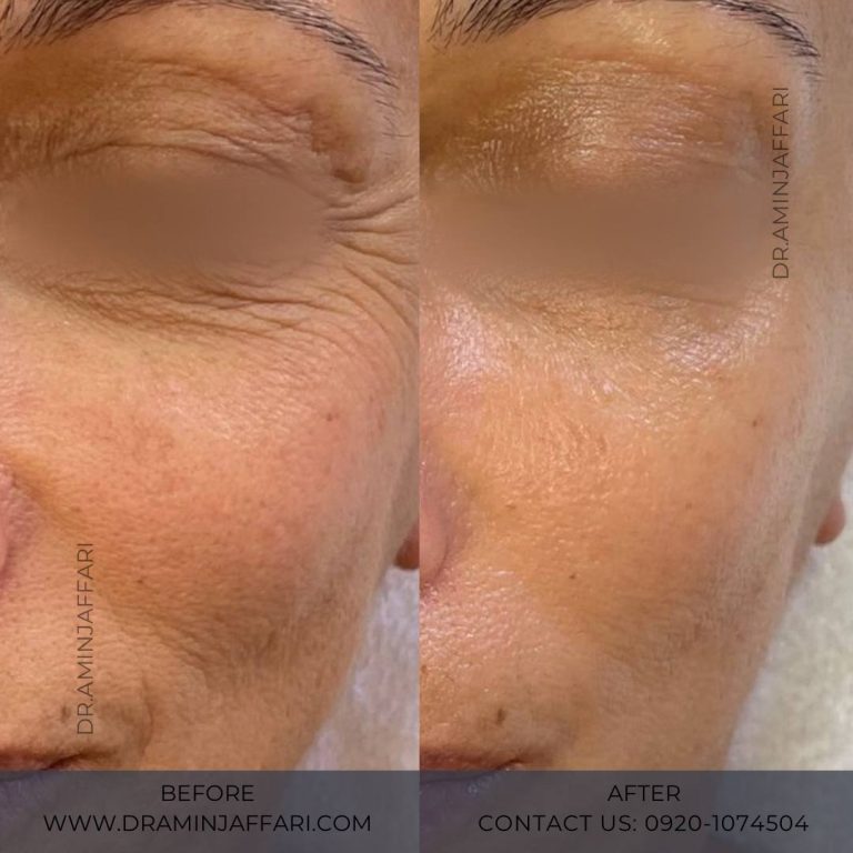 اندولیفت دکتر امین جعفری (8)