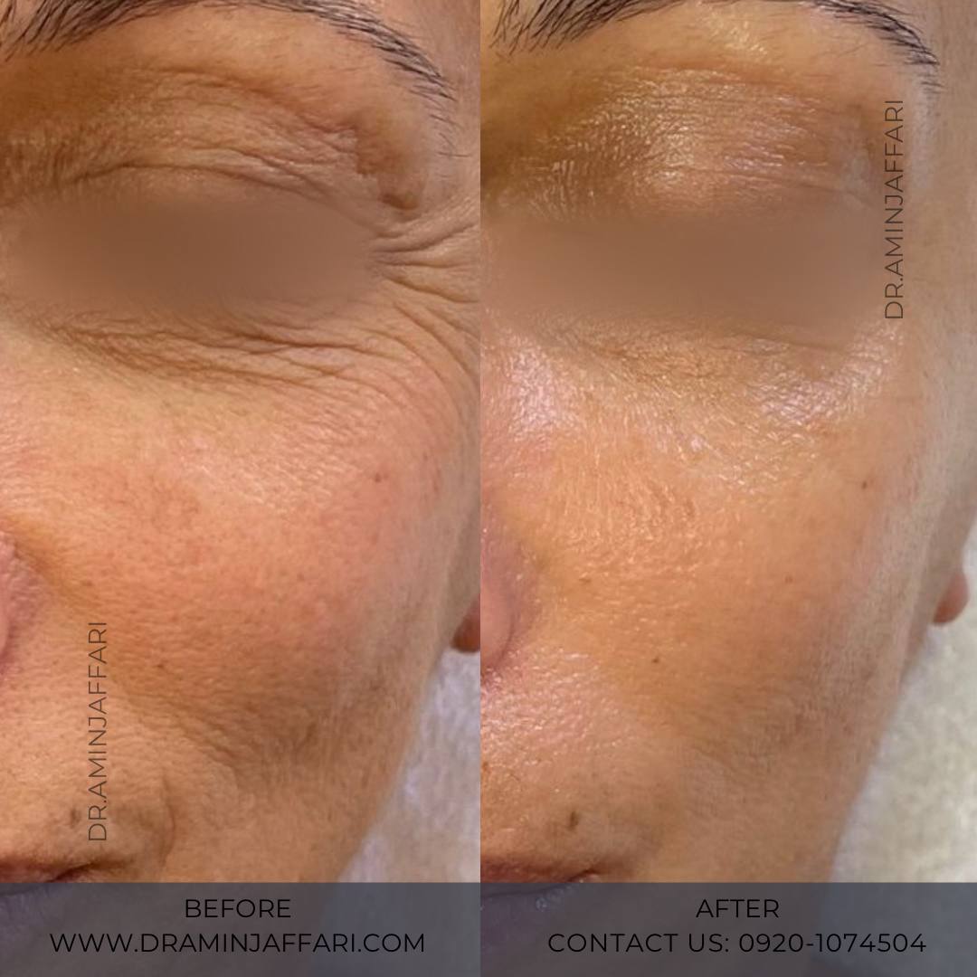 اندولیفت دکتر امین جعفری (8)