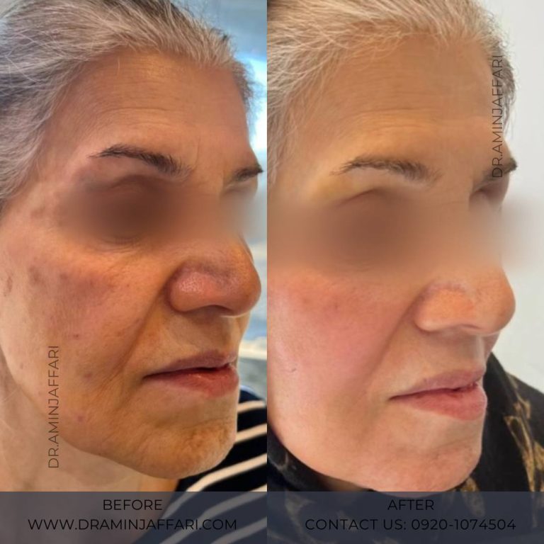 اندولیفت دکتر امین جعفری (9)