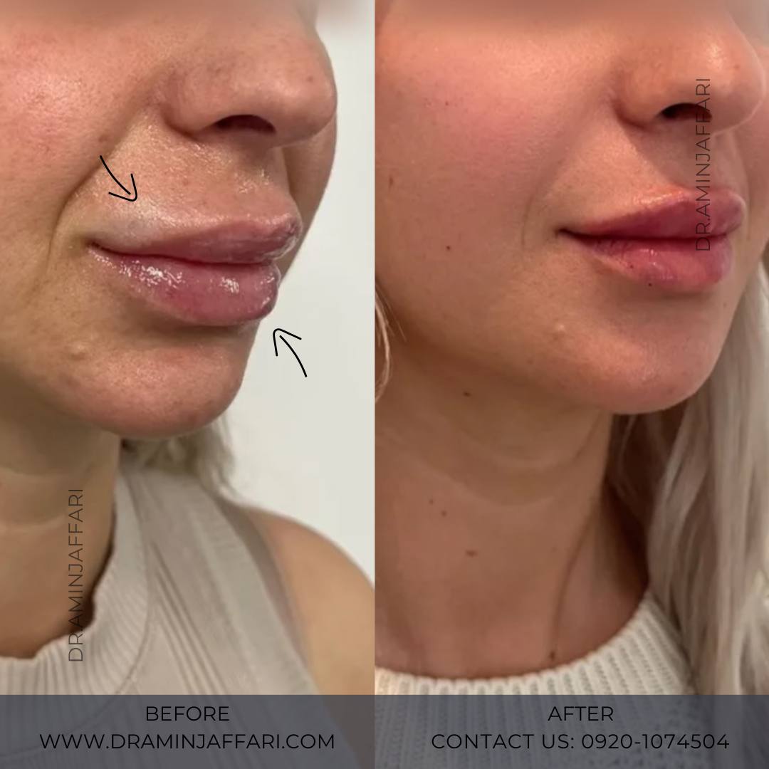 تخلیه ژل اجزای صورت