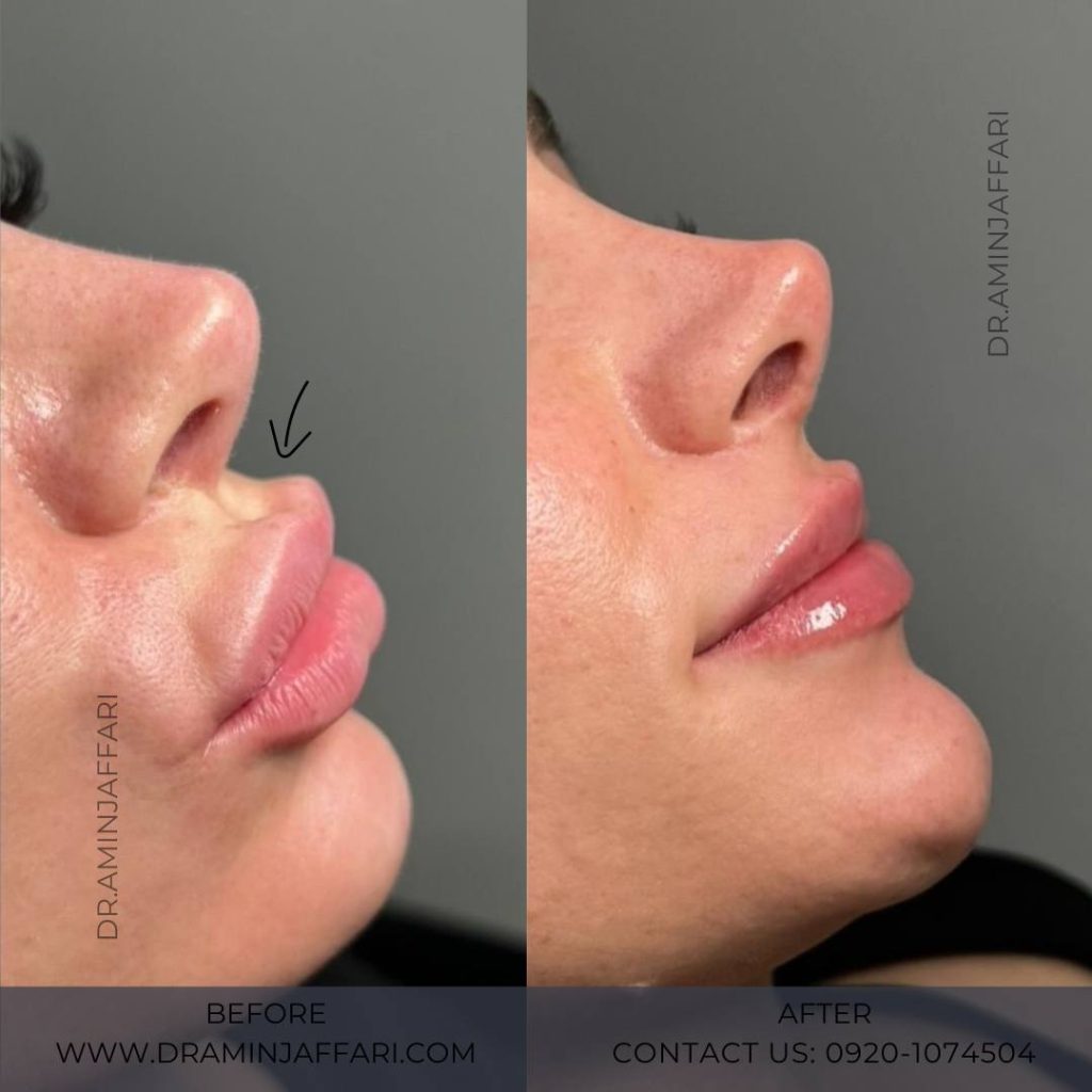 تخلیه ژل دکتر امین جعفری (5)