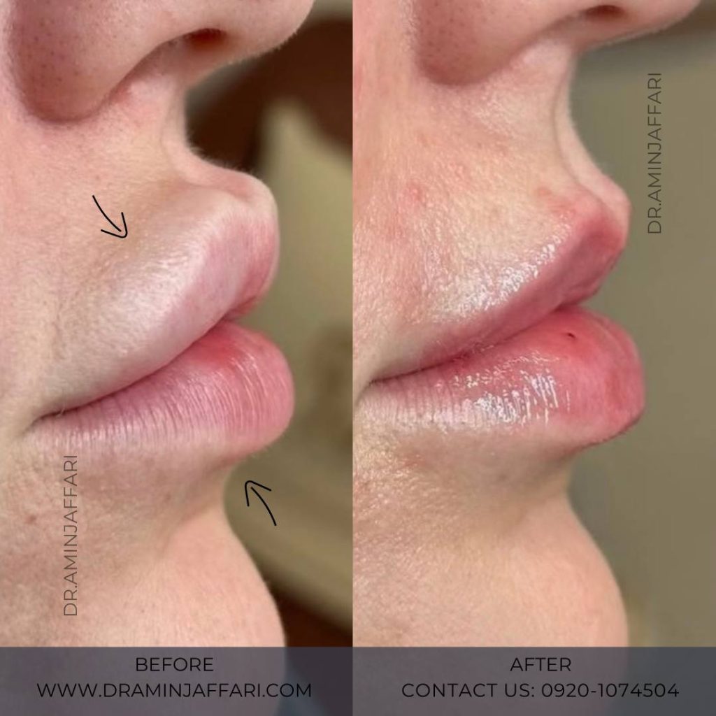 تخلیه ژل دکتر امین جعفری (9)