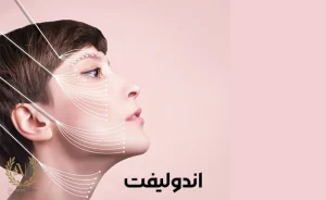 مزیت های اندولیفت