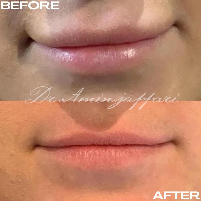 نمونه کار تخلیه ژل