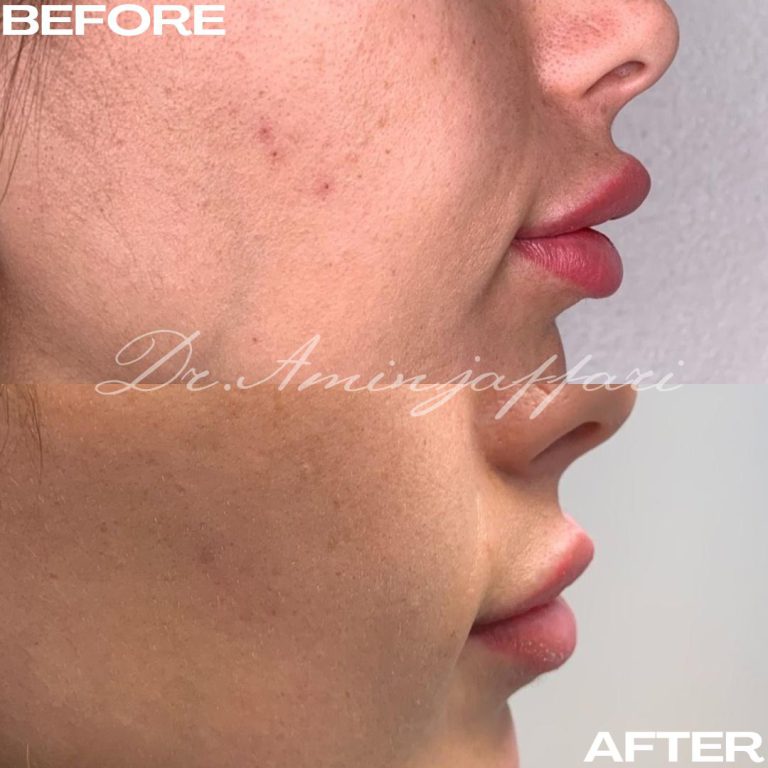 نمونه کار تخلیه ژل