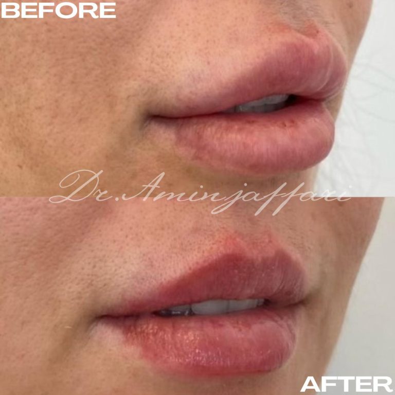 نمونه کار تخلیه ژل