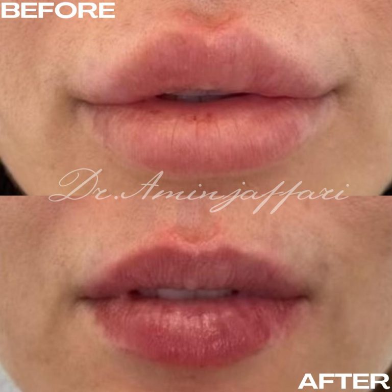 نمونه کار تخلیه ژل
