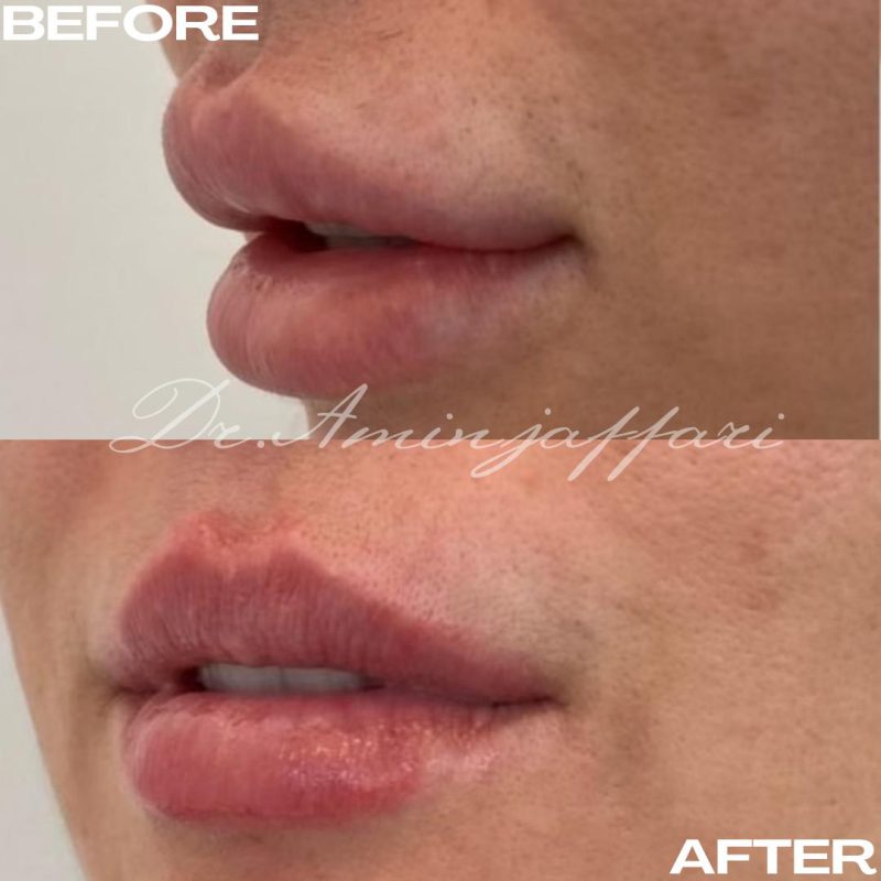 نمونه کار تخلیه ژل