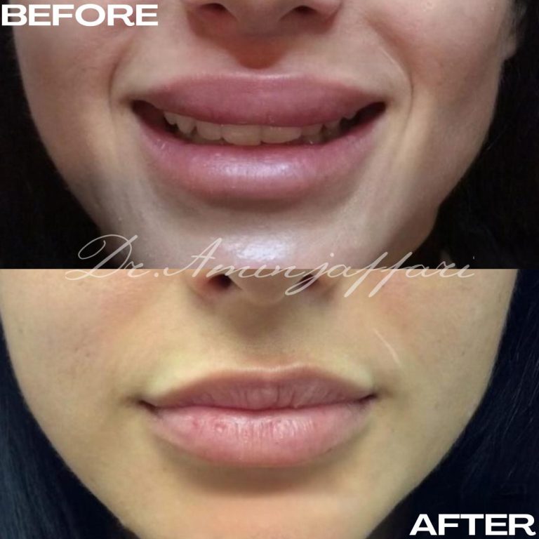 نمونه کار تخلیه ژل