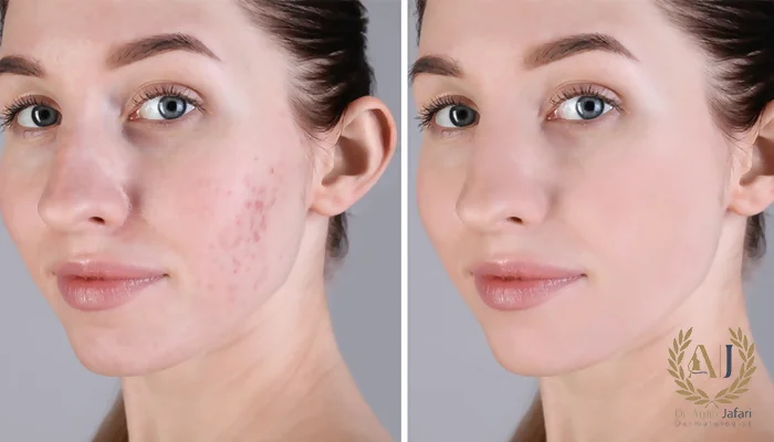 درمان جای جوش با اندولیفت