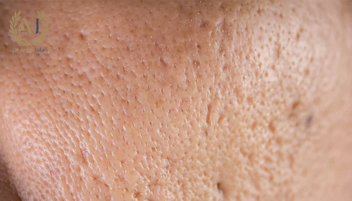 اندولیفت جای جوش