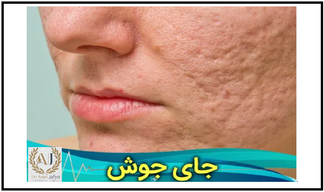 پیشگیری از جای جوش