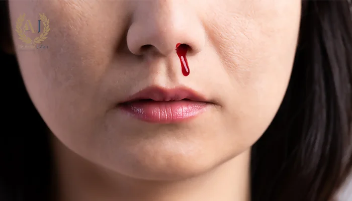 علائم نکروز بینی