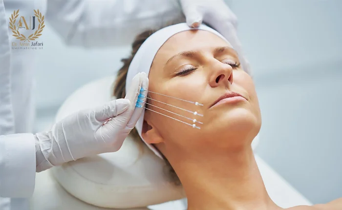 لیفت نخ صورت چیست؟