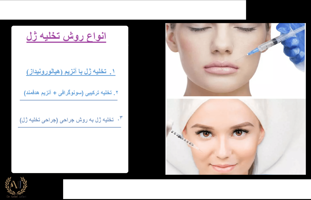 تخلیه ژل انواع روش ها