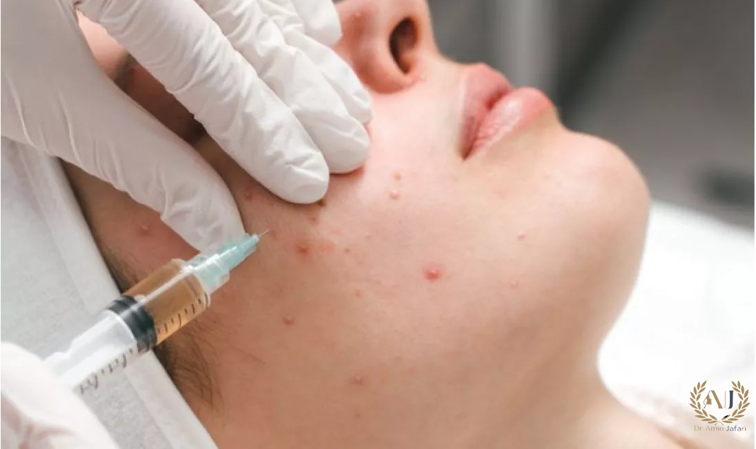 پی ار پی صورت face prp