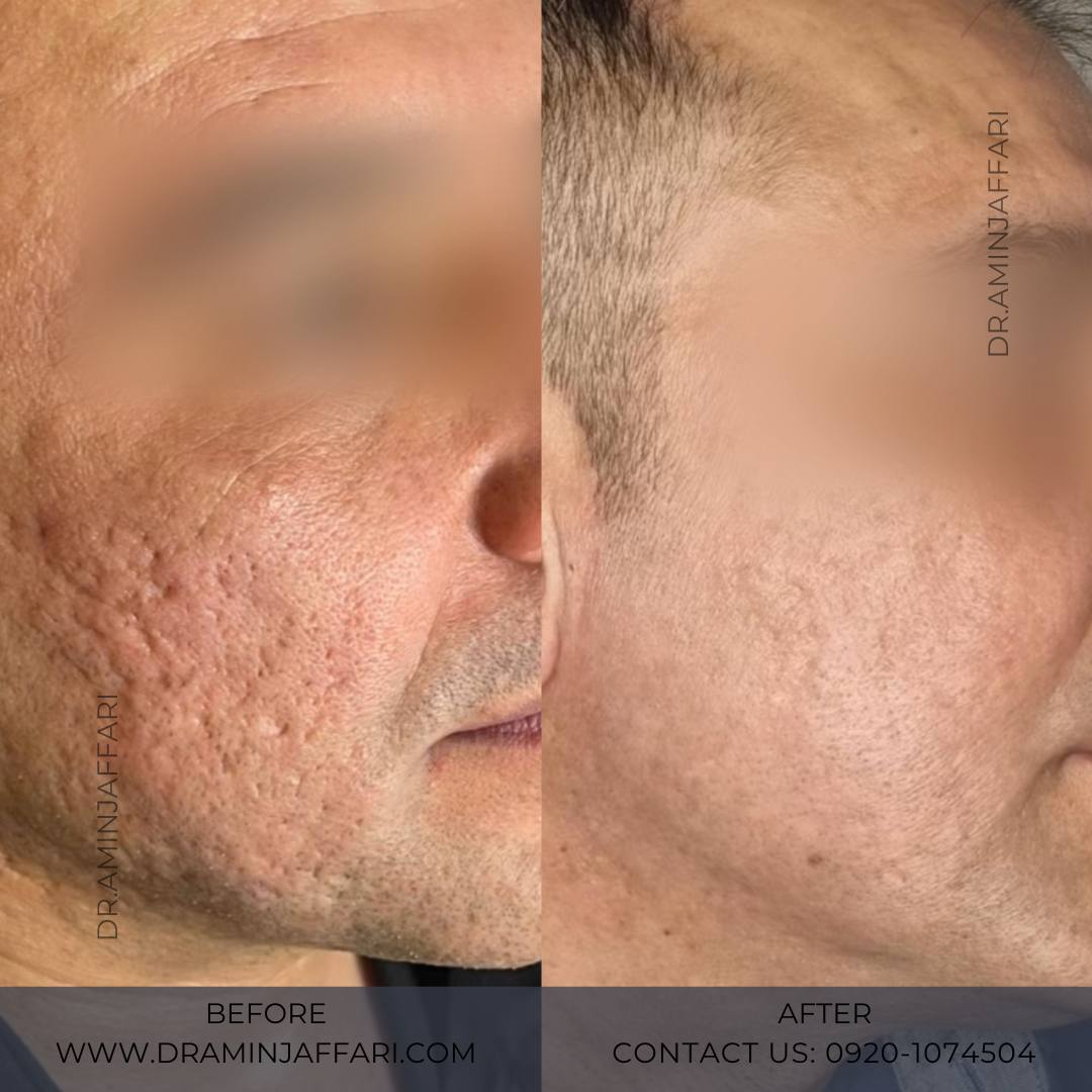 درمان جای جوش و لک -دکتر امین جعفری (11)