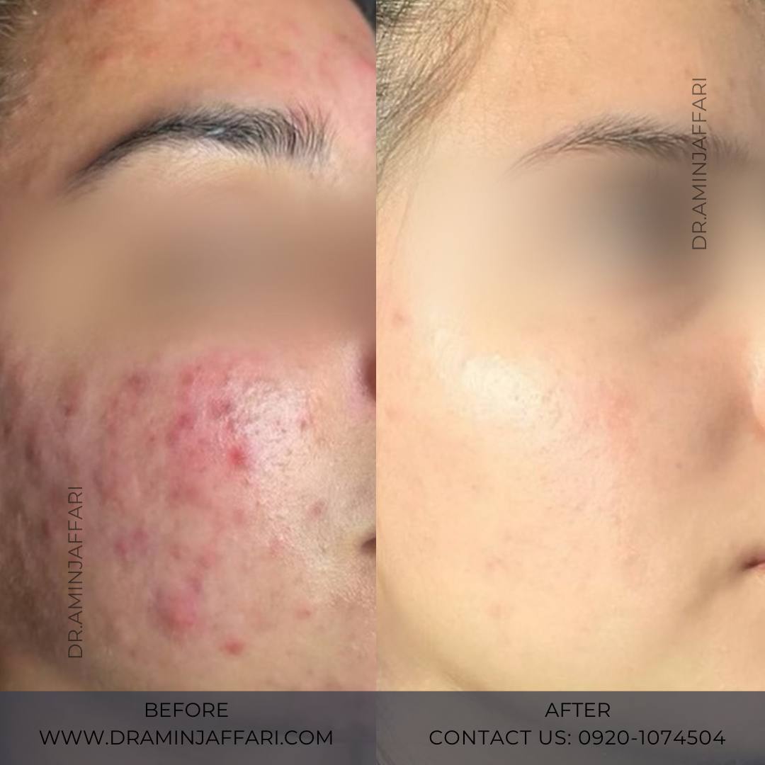 درمان جای جوش و لک -دکتر امین جعفری (5)