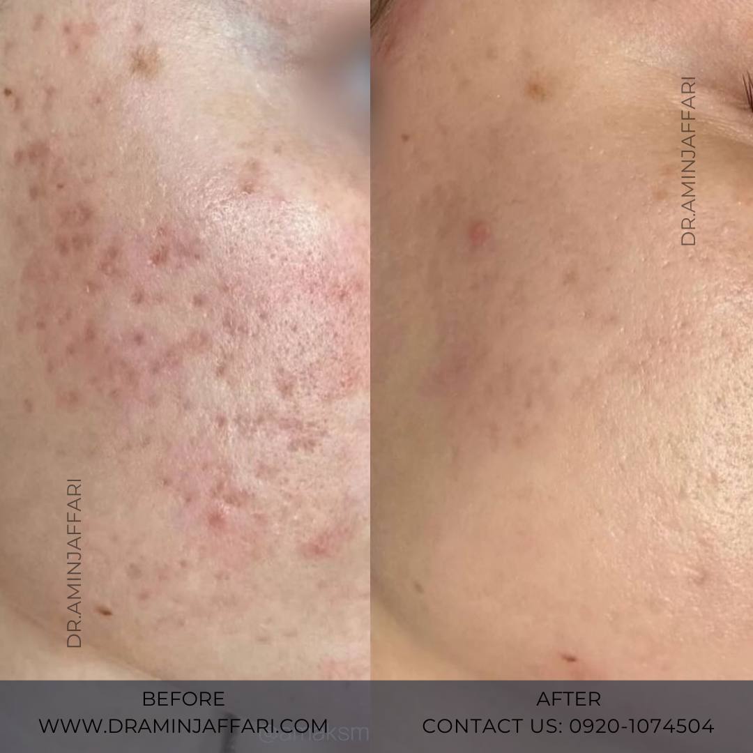 درمان جای جوش و لک -دکتر امین جعفری (7)