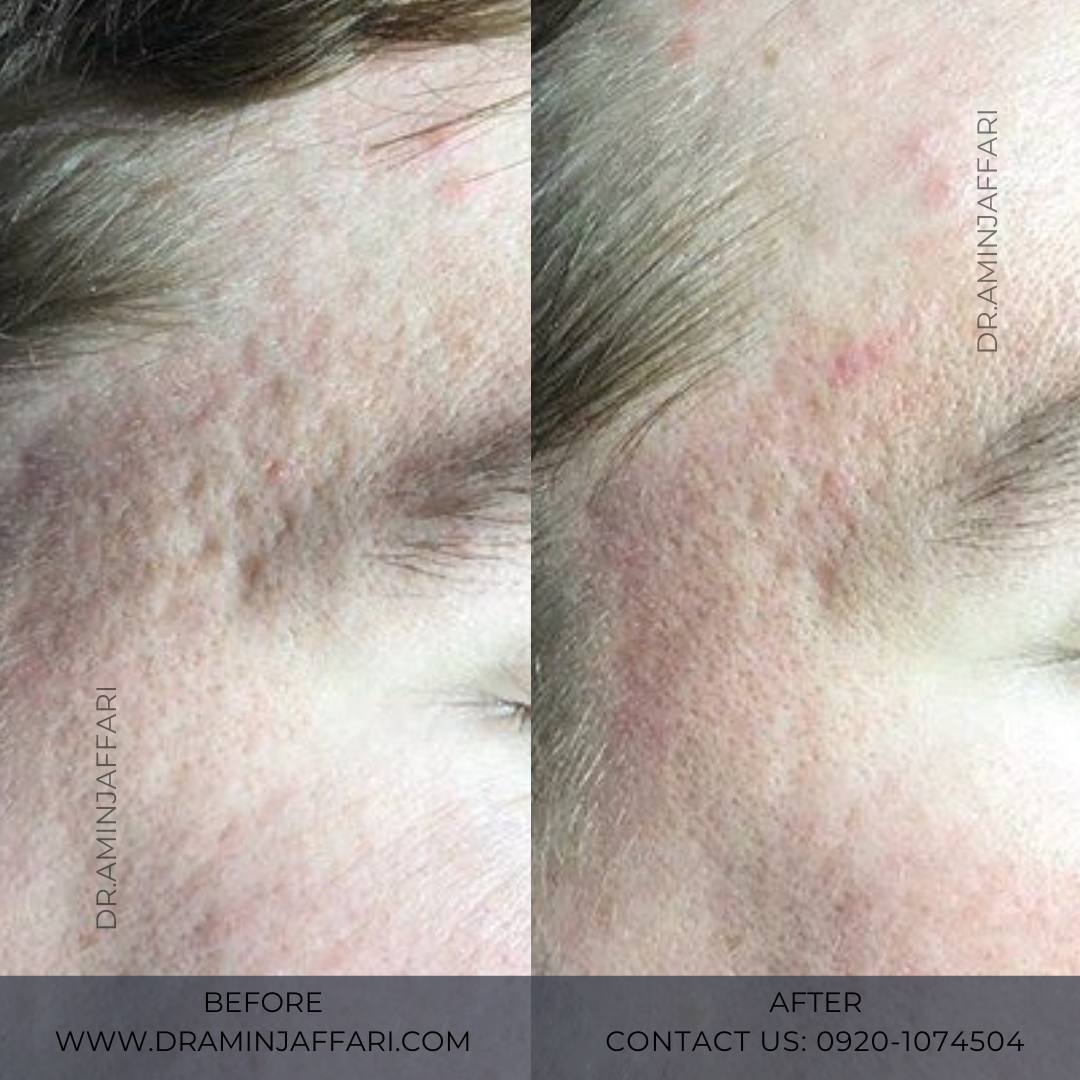 درمان جای جوش و لک -دکتر امین جعفری (9)