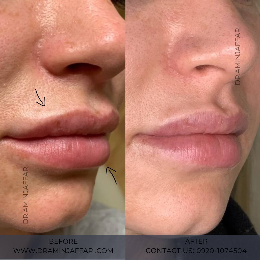 تخلیه ژل - دکتر امین جعفری (13)