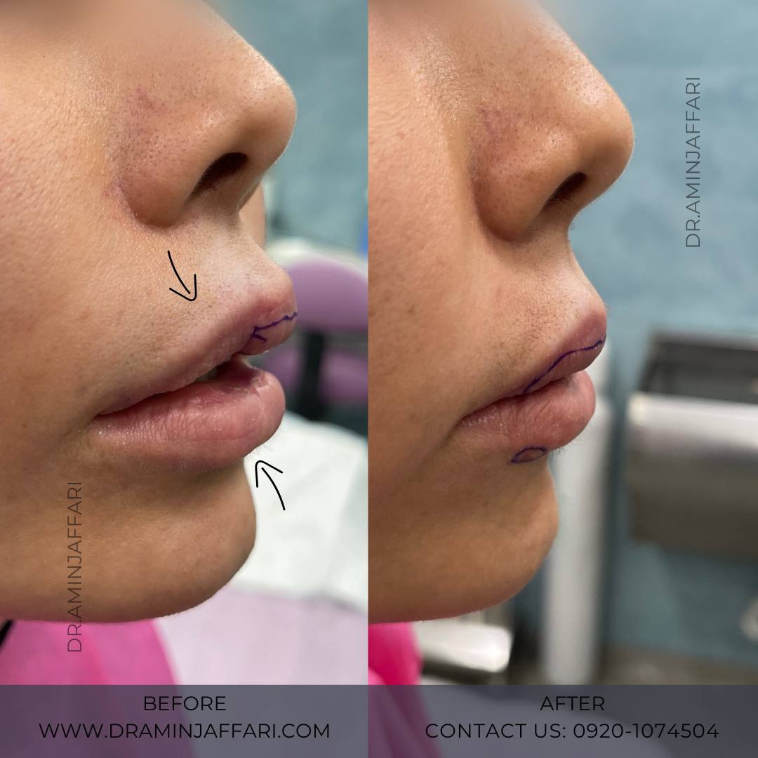 تخلیه ژل - دکتر امین جعفری (14)