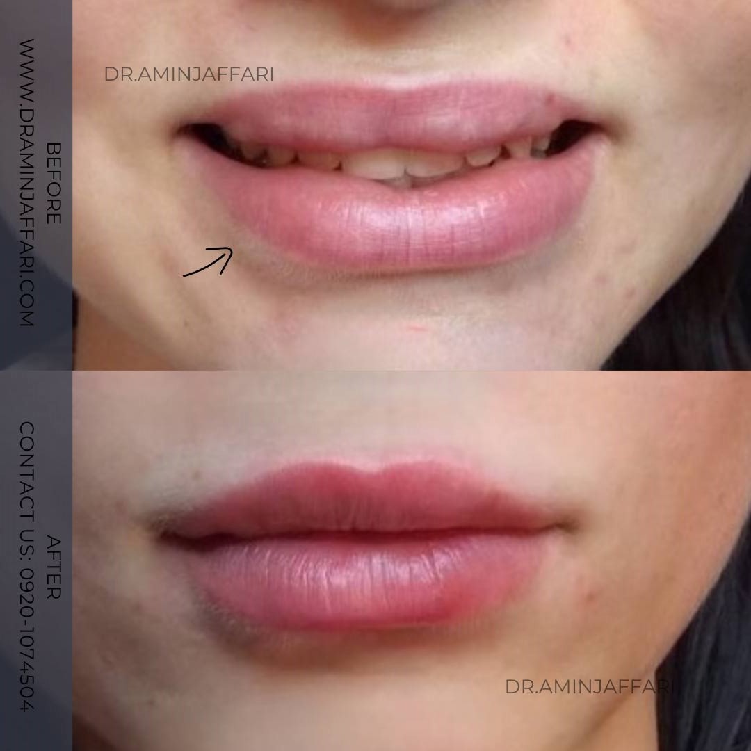 تخلیه ژل - دکتر امین جعفری (15)