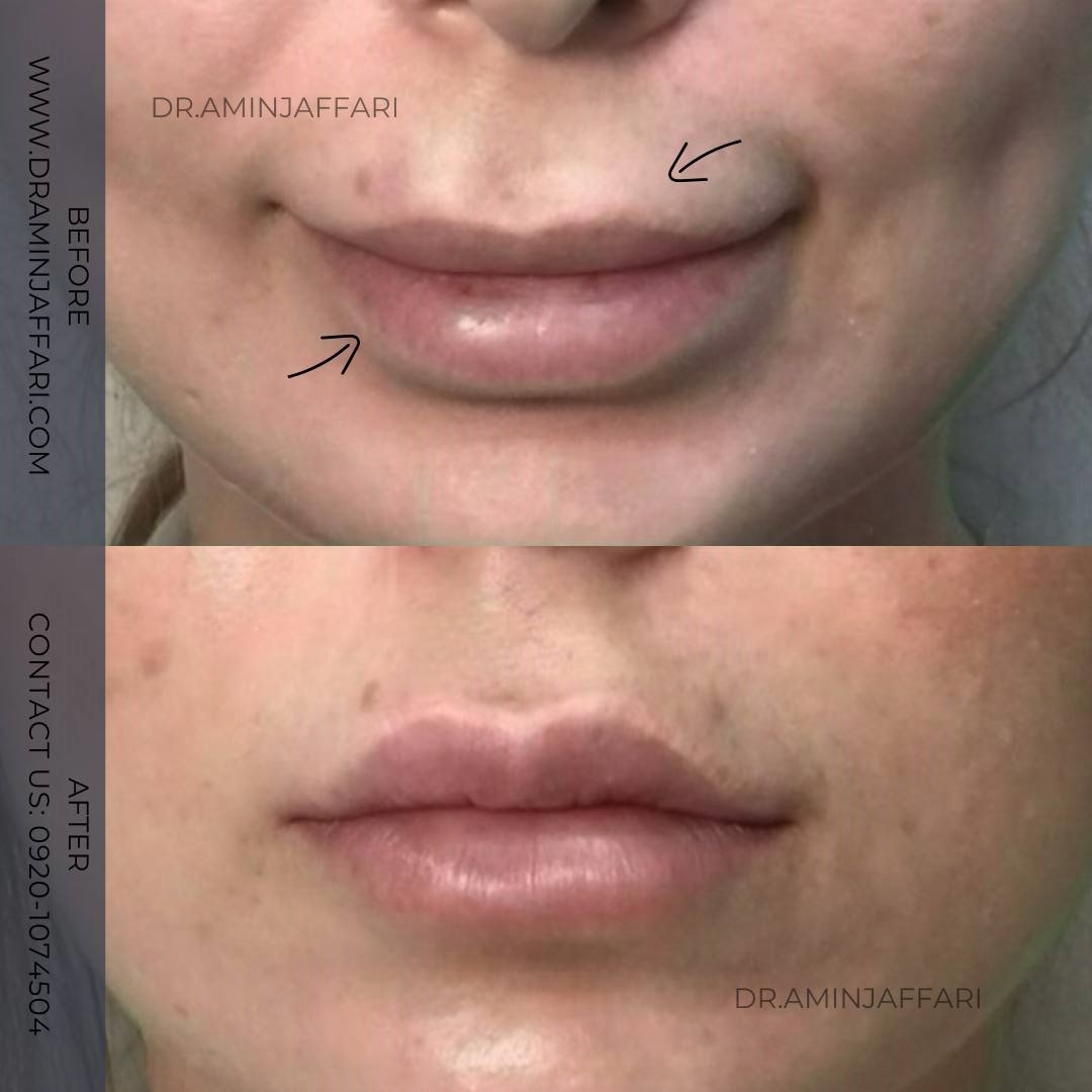 تخلیه ژل - دکتر امین جعفری (16)