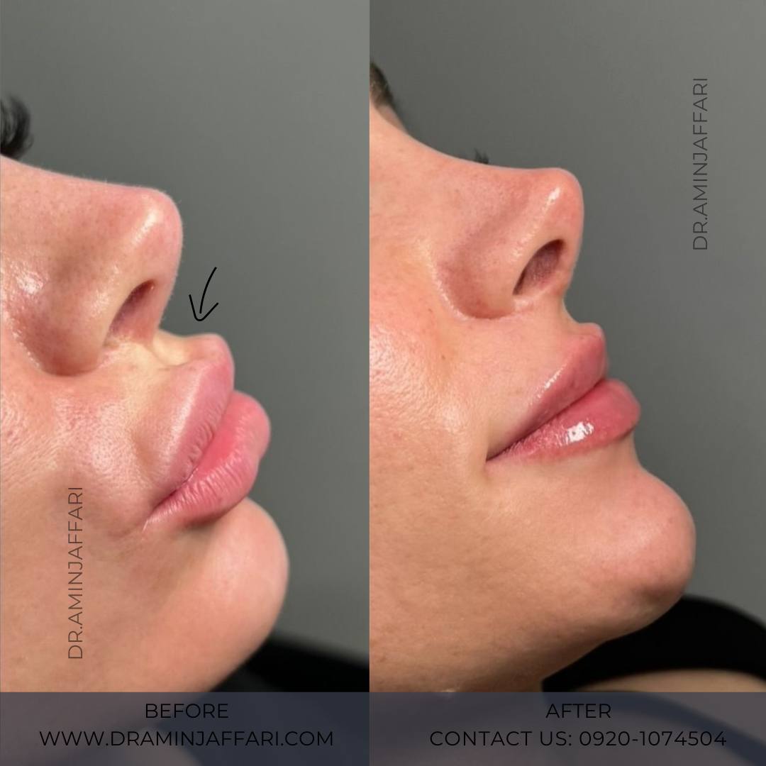 تخلیه ژل - دکتر امین جعفری (2)