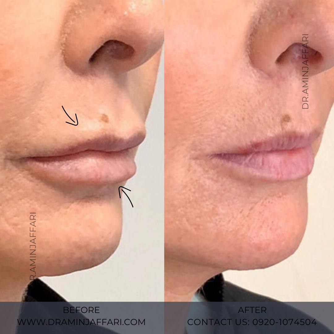 تخلیه ژل - دکتر امین جعفری (4)