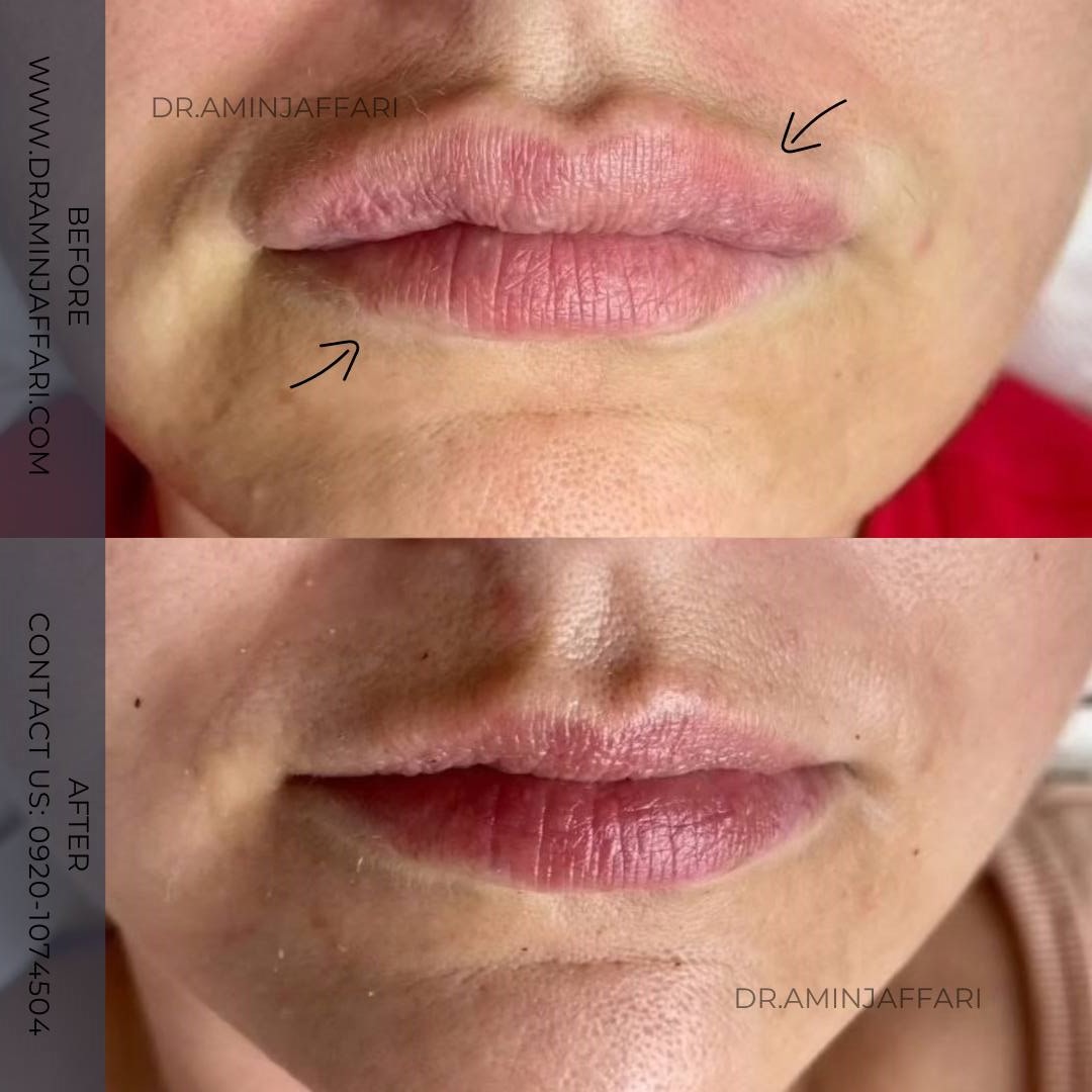 تخلیه ژل - دکتر امین جعفری (6)