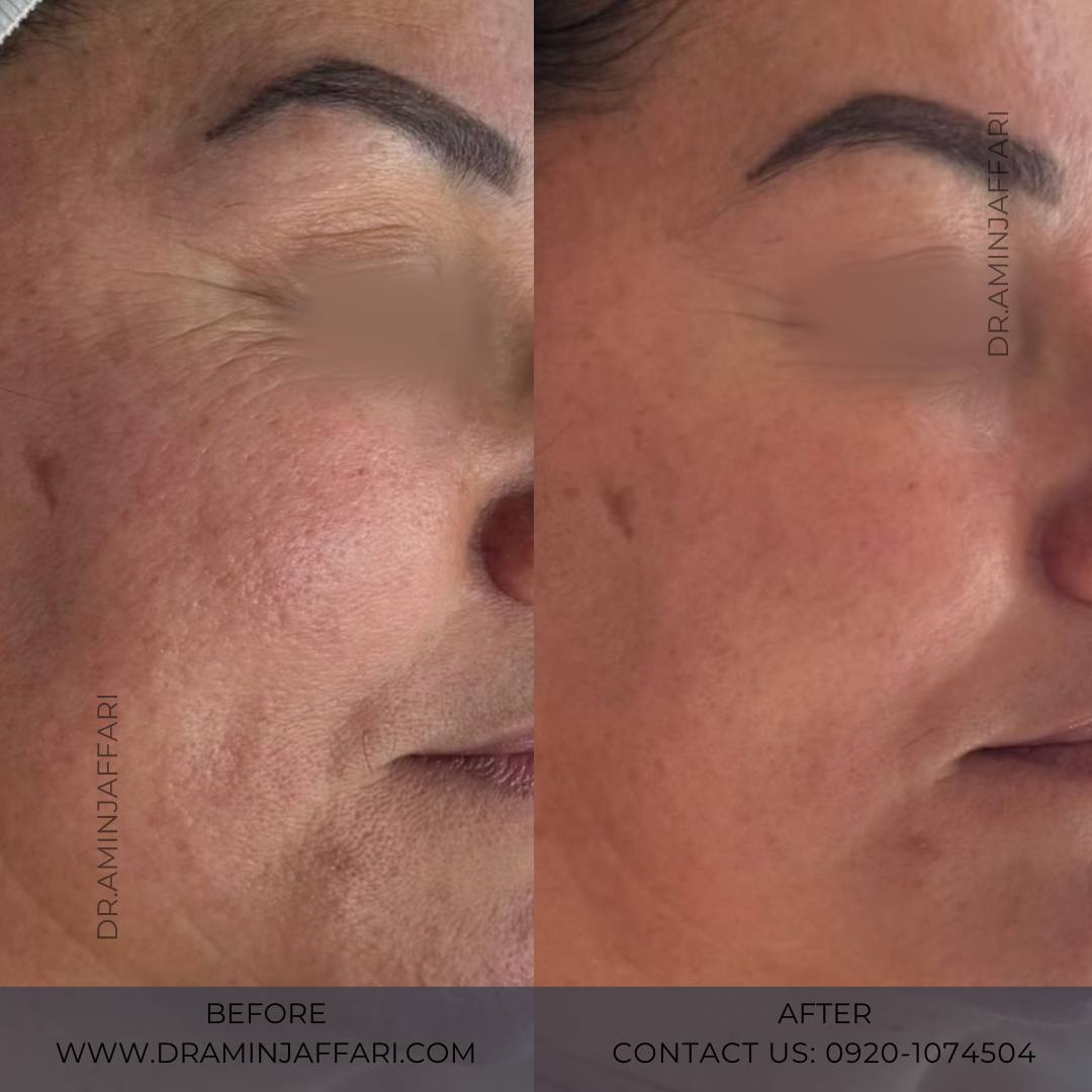 اندولیفت دکتر امین جعفری (3)