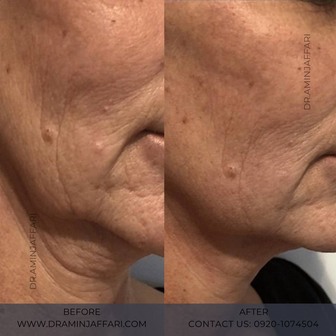 اندولیفت دکتر امین جعفری (4)