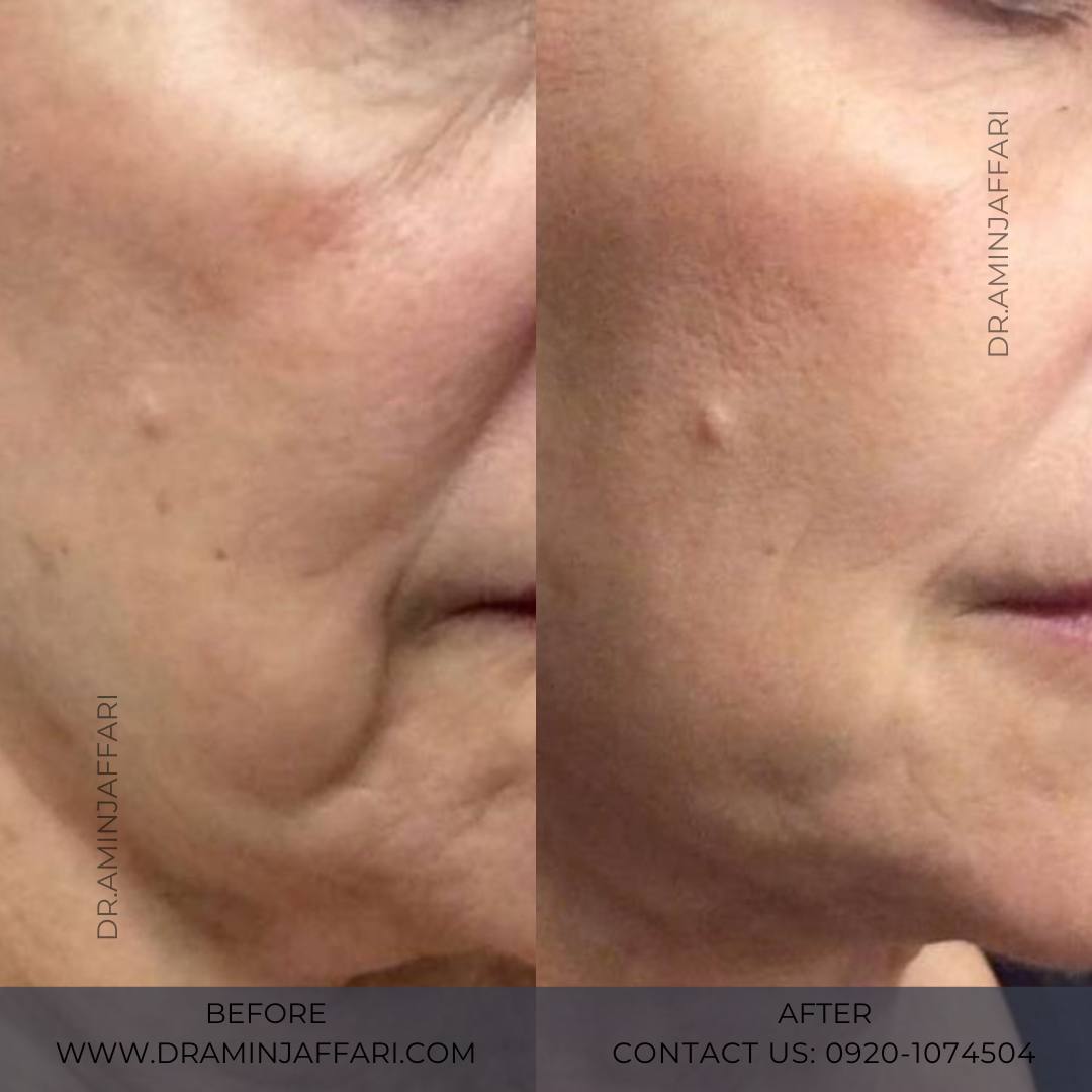 اندولیفت دکتر امین جعفری (5)