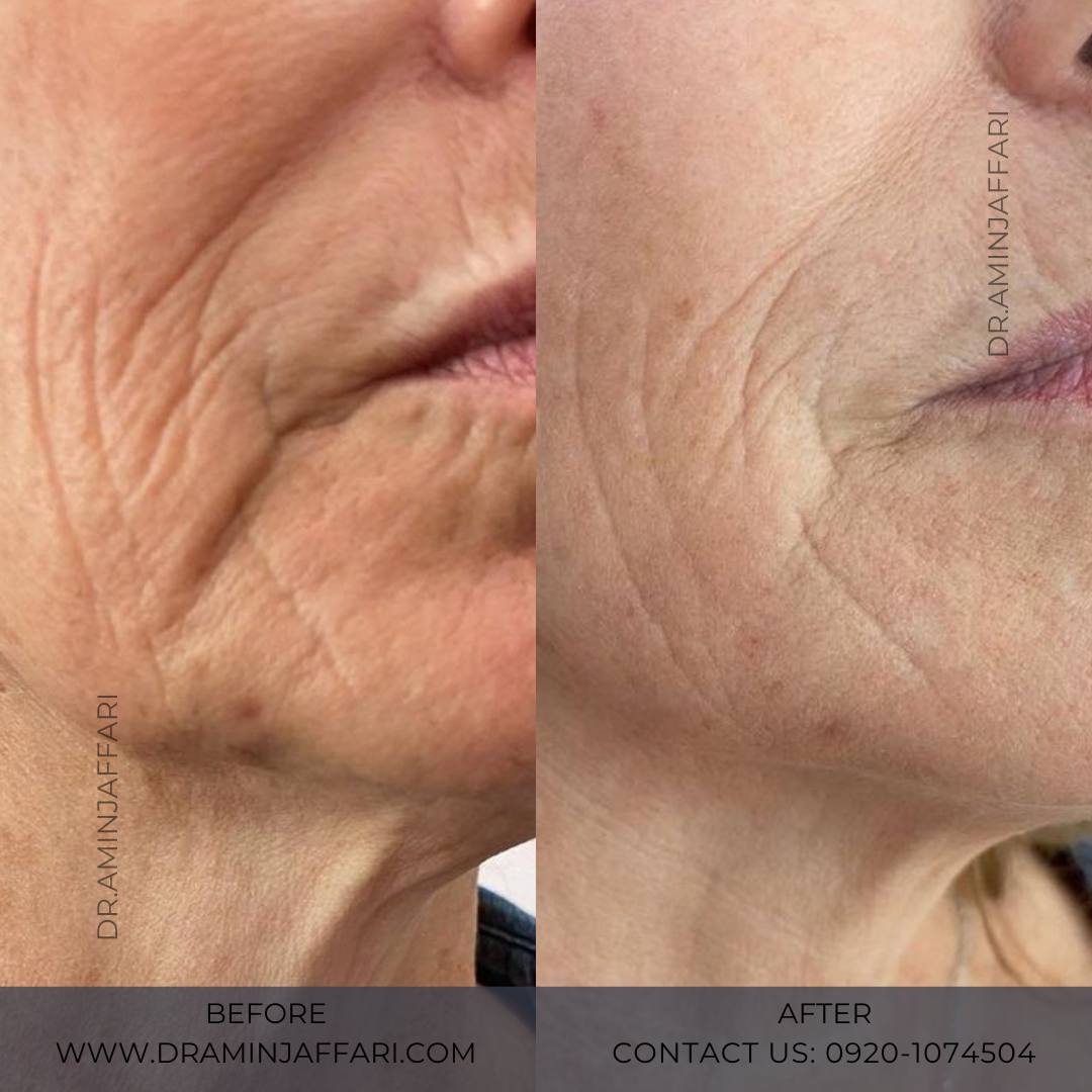 اندولیفت دکتر امین جعفری (7)