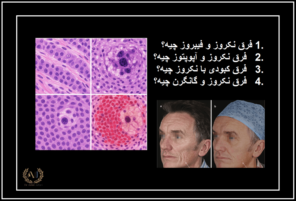 نکروز چیست فرق نکروز و فیبروز