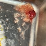 تخلیه ژل بیکینی دکتر امین جعفری.