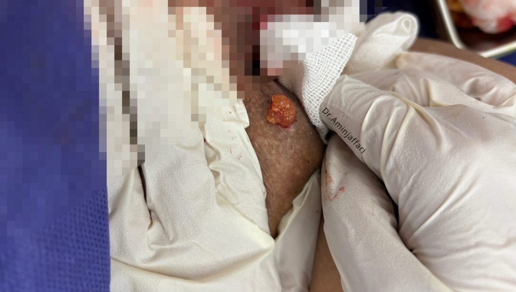 تخلیه ژل بیکینی دکتر امین جعفری