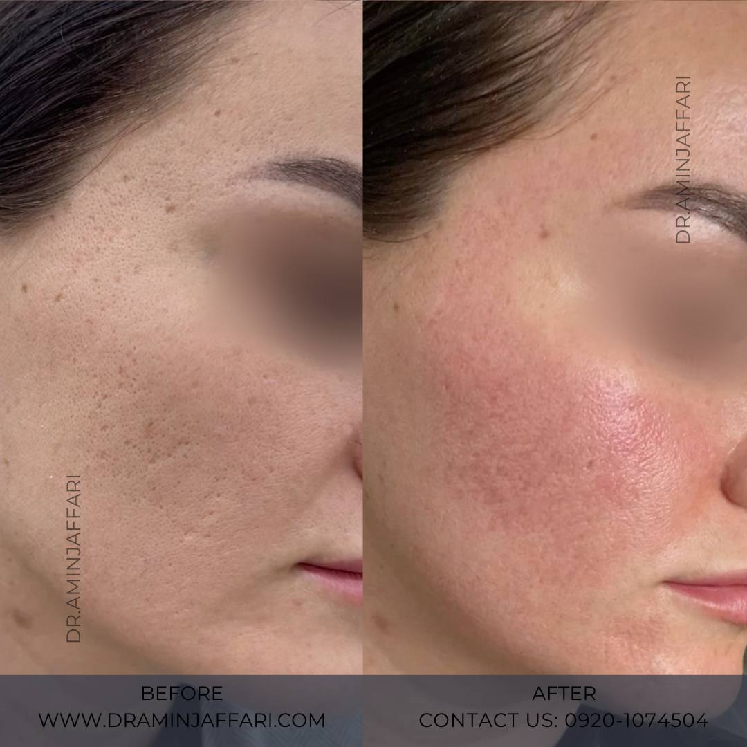 درمان جای جوش و لک -دکتر امین جعفری (2)
