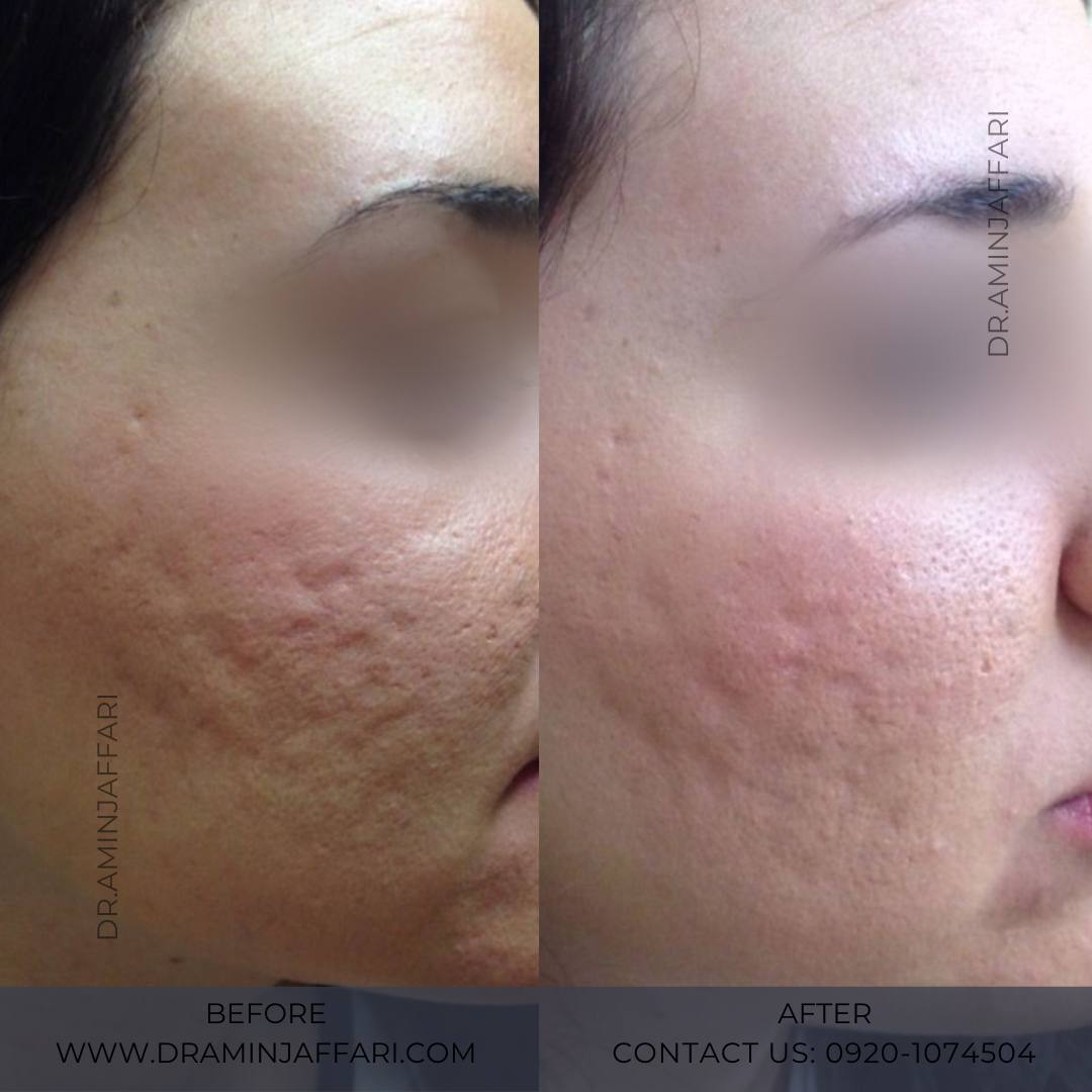 علاج آثار الحبوب مع اندوليفت